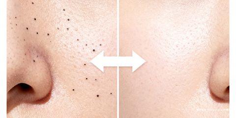 黑头粉刺（Blackheads）属于开放性粉刺，主要由皮脂、角质与污垢堆积于毛孔，并经氧化后形成。由于角质在其中扮演关键角色，许多人认为「去角质」是解决黑头的有效方法。然而，去角质并非万灵丹，若方式不当，反而可能伤害皮肤屏障，让黑头与敏感问题更严重。本文将解析去角质与黑头的关联，并整理专家建议。