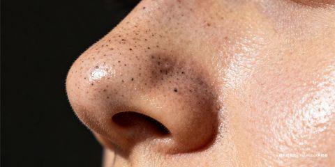 黑头粉刺（Blackheads）常见于鼻头、额头与下巴等油脂分泌旺盛的区域。许多人认为黑头与「油」有关，因此忽略了保湿的重要性，甚至刻意减少乳液或面霜的使用。然而，皮肤在缺水状态下会导致皮脂补偿性分泌过多，反而使黑头更严重。正确的保湿策略是黑头肌肤护理中不可或缺的一环。