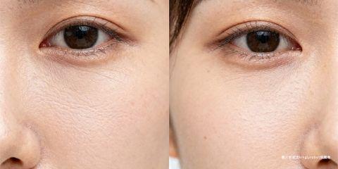细纹是肌肤老化与环境影响下最常见的表现之一，但并非所有细纹成因相同。临床上常将细纹分为干纹与动态纹两大类型。前者多因皮肤缺水或屏障受损而产生，后者则源于长期肌肉收缩与表情习惯。正确认识两种细纹，才能针对性预防与改善。