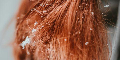 穿上深色衣服总是战战兢兢,怕一低头白屑也一起悄悄落下。换了好几款洗发精,效果都只是昙花一现…到底要怎么改善头皮屑呢?别担心,今天就让本篇文章教你几招,让你摆脱雪花肩。