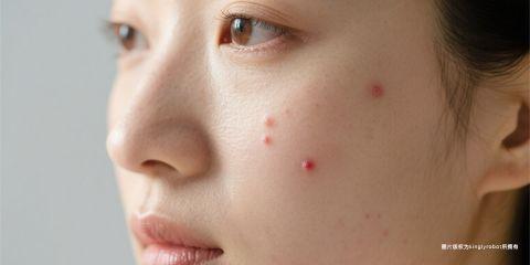 皮肤状态不仅取决于外用保养,还与日常饮食息息相关。越来越多研究显示,饮食结构会直接影响 皮脂腺分泌与皮肤油水平衡。某些食物可能刺激油脂分泌过度,使脸部更容易出油,甚至导致粉刺与痘痘。了解这些食物并适度控制,有助于维持肤质稳定。