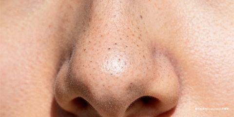 黑头粉刺(Blackheads)属于开放性粉刺,是油脂、角质与污垢堵塞毛孔后,与空气接触氧化所形成的黑点。许多人虽经常清理,却发现黑头总是「清不干净」,甚至越清越多。这往往与错误的清洁观念与护理方法有关。本文将解析黑头难以彻底清除的原因,并揭露常见误区。