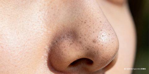 现代人生活步调紧凑,长期处于压力环境下,不仅影响心理健康,也会对皮肤造成负面影响。许多人发现,一旦压力大或睡眠不足,脸上黑头、粉刺与痘痘就会变多。这背后的关键因素之一,就是压力相关的荷尔蒙变化。本文将解析压力如何透过荷尔蒙影响皮肤,进而加重黑头问题。