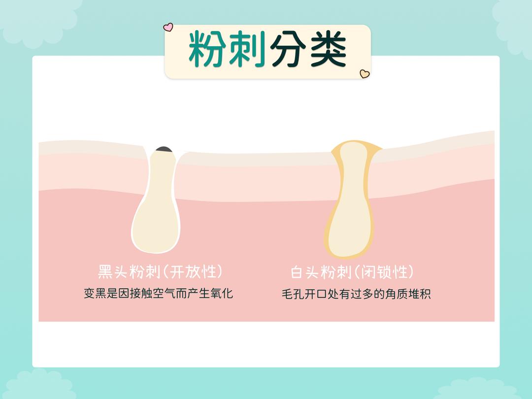 粉刺的种类有哪些?