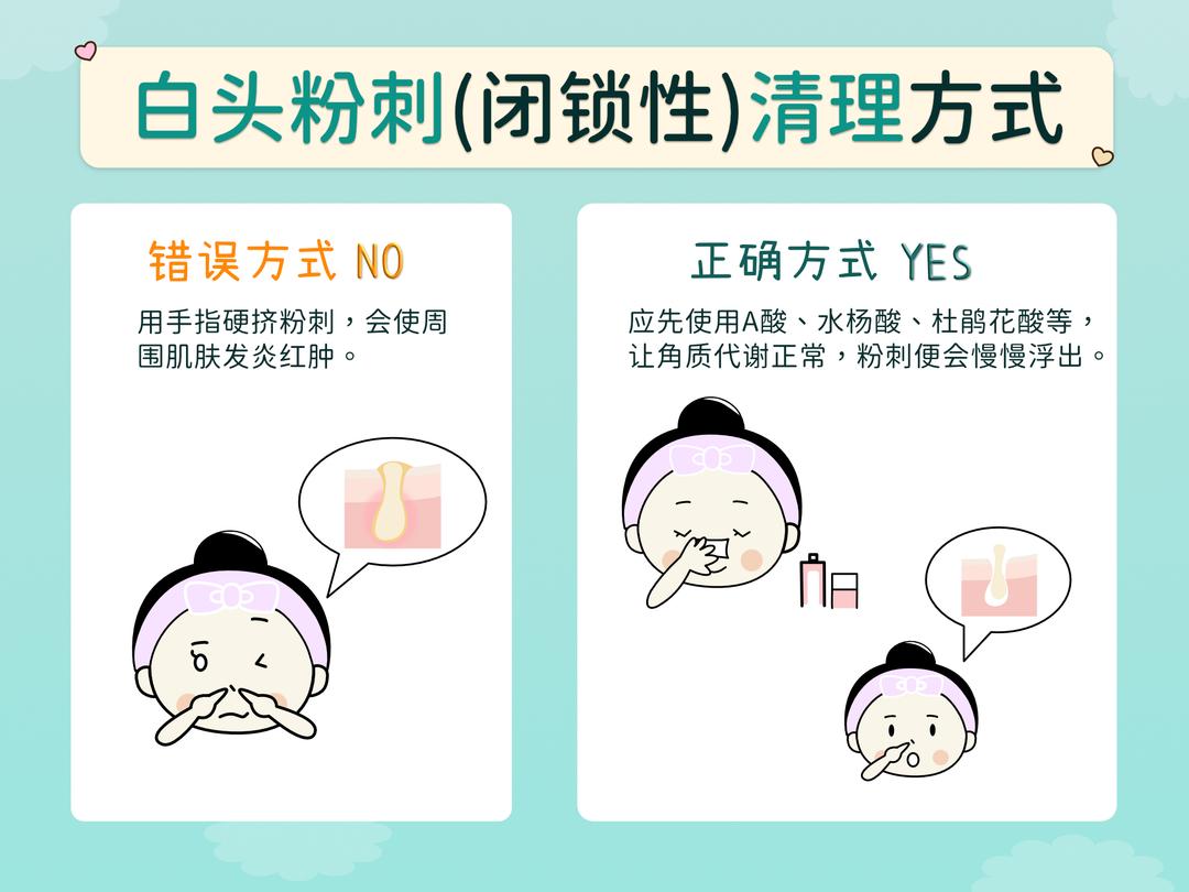 如何去除白头粉刺?