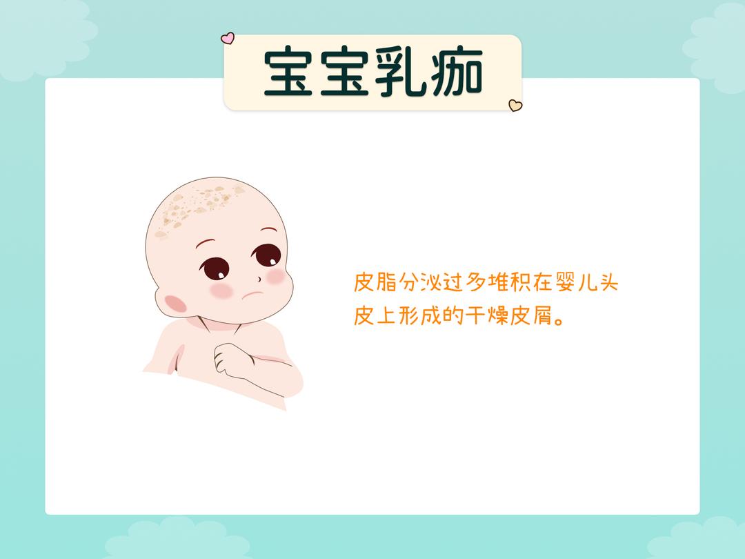 宝宝肌肤问题-乳痂 (头皮上的干燥皮屑)