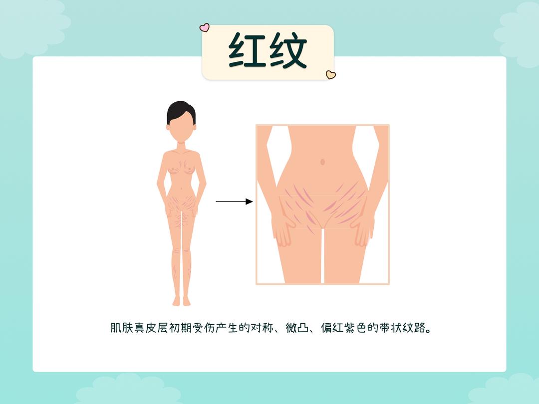 妊娠纹的成因