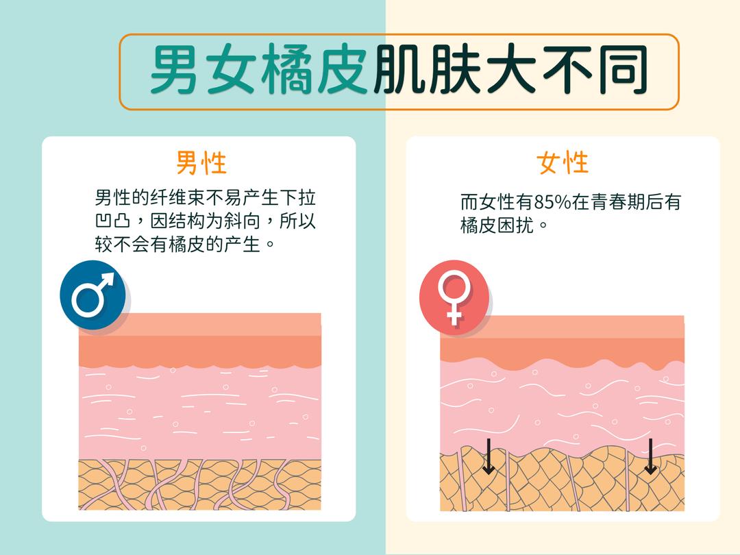 女性较容易有橘皮困扰?